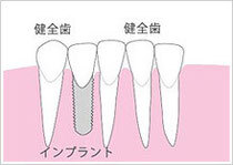 インプラントで治療すると