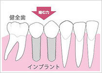 インプラントで治療すると