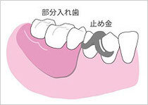 局部床義歯＝部分入れ歯