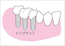 インプラントで治療すると