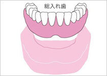 全部床義歯＝総入れ歯