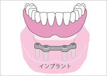 インプラントで治療すると