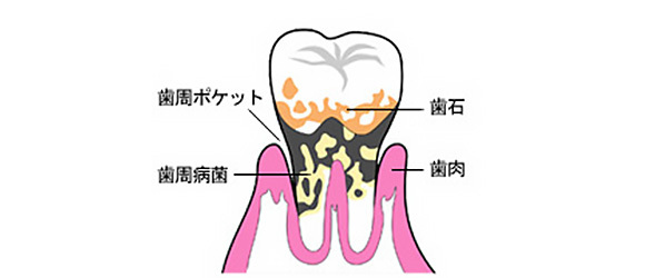 歯周病とは？